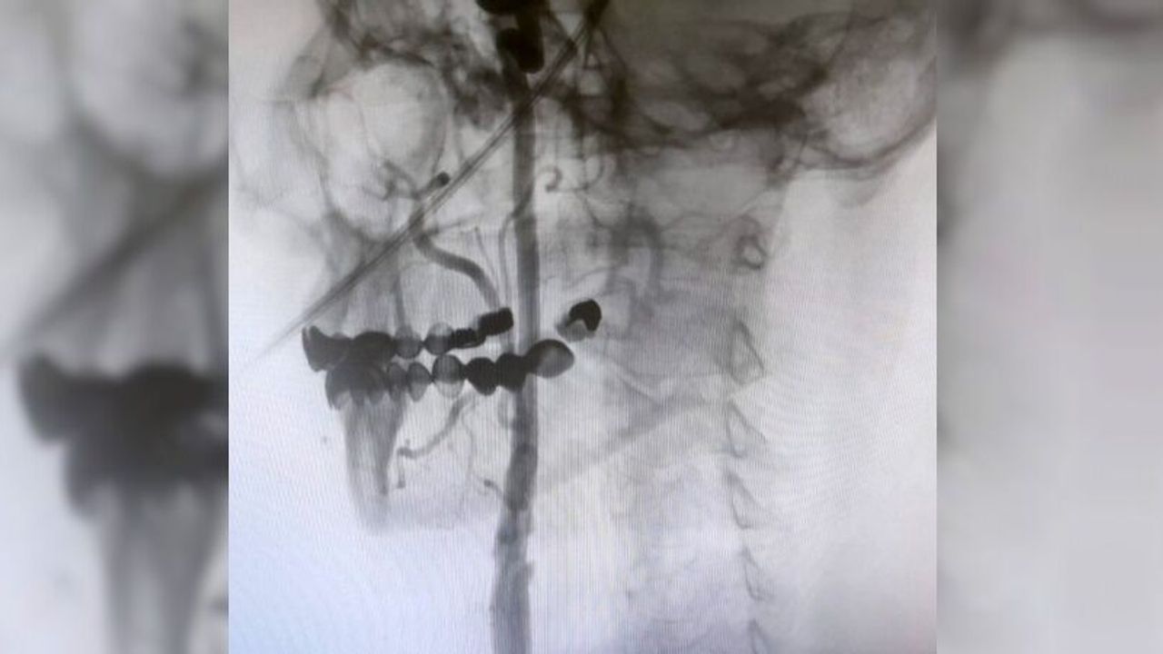 Manisa Şehir Hastanesi’nde felç riskine karşı ameliyatsız çözüm