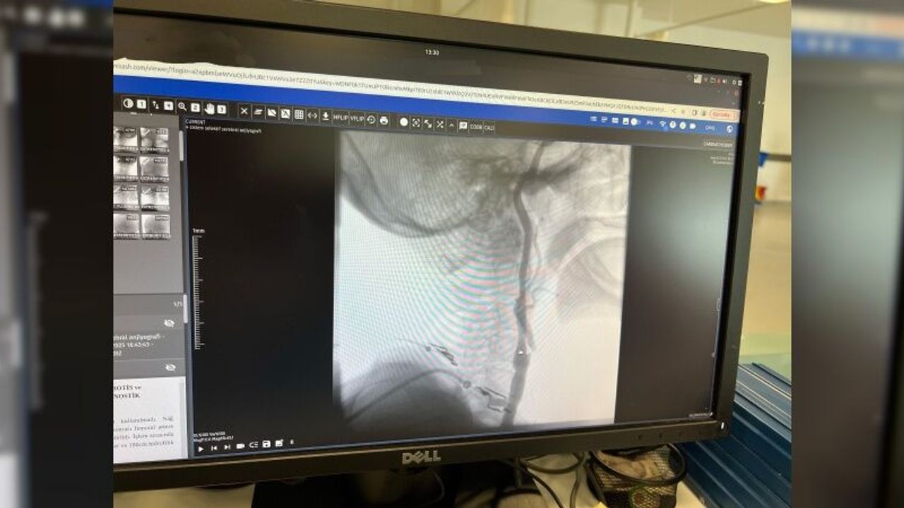 Manisa Şehir Hastanesi’nde felç riskine karşı ameliyatsız çözüm