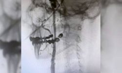 Manisa Şehir Hastanesi’nde felç riskine karşı ameliyatsız çözüm