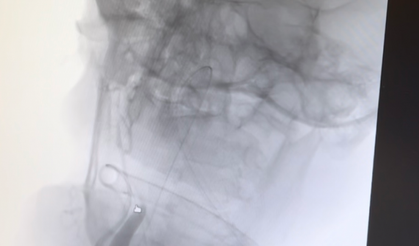 Felç Geçiren Hasta, Şehir Hastanesi’nde zamanında müdahaleyle hayata tutundu