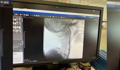 Manisa Şehir Hastanesi’nde felç riskine karşı ameliyatsız çözüm