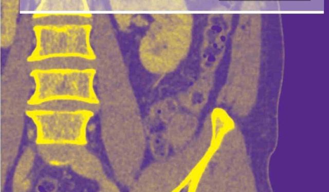 Akciğer damarındaki pıhtıların tanısında radyasyonsuz çözüm