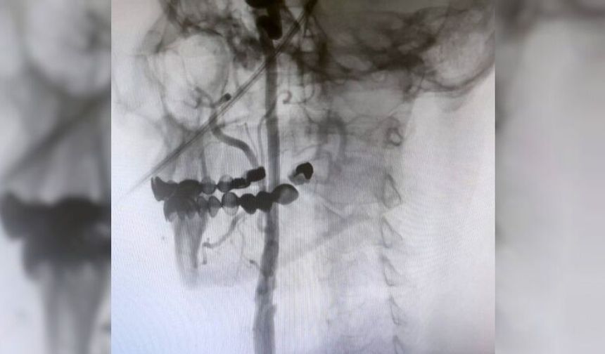 Manisa Şehir Hastanesi’nde felç riskine karşı ameliyatsız çözüm