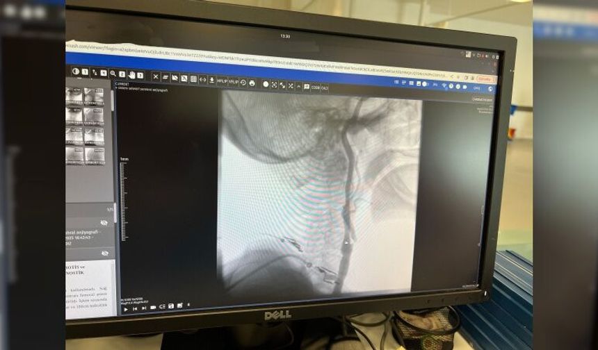 Manisa Şehir Hastanesi’nde felç riskine karşı ameliyatsız çözüm